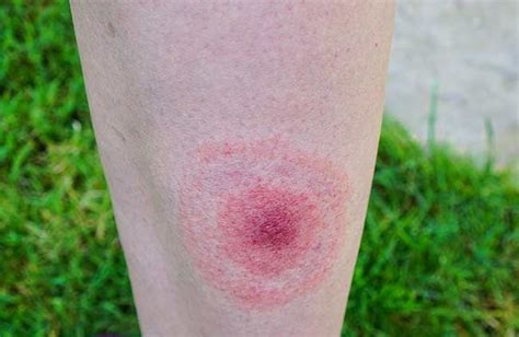Lyme Disease All You Need To Know And How To Avoid Tick Bites