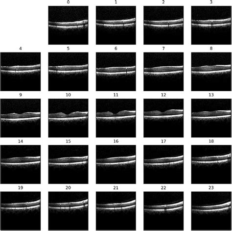 prediction of sex and age from macular optical coherence tomography images and feature analysis