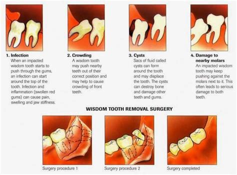 Pin By Sushen Sharma On Dentistry Impacted Wisdom Teeth Wisdom Teeth