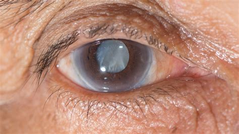 Cataract Evaluation And Surgery Pgheyemeds