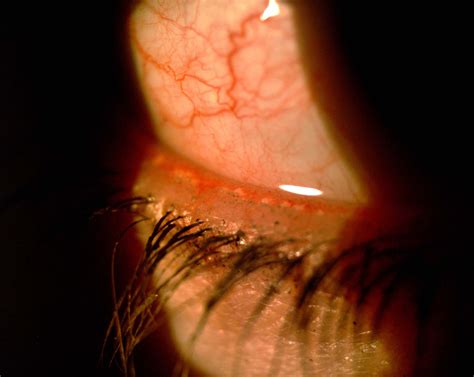 Meibomian Gland Dysfunction Severe Eye Health Gland Severe