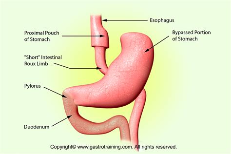 Gastroenterology Education And Cpd For Trainees And Specialists Roux En Y Gastric Bypass