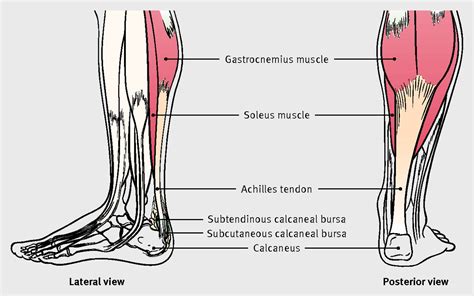 Achilles Tendon Disorders The Bmj