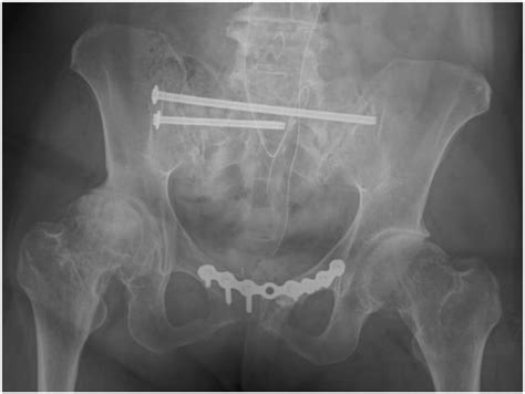 Postoperative Anteroposterior Pelvic Radiograph After Stabilization Of