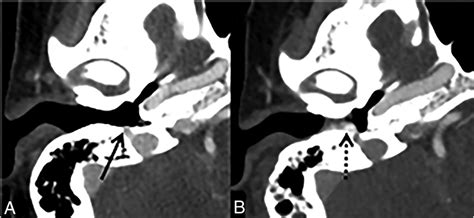 Beyond Tympanomastoidectomy A Review Of Less Common Postoperative