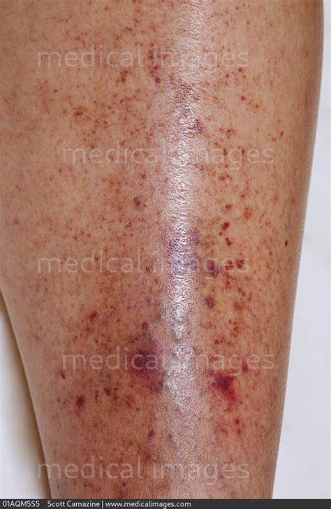 Stock Image Petechiae And Purpura Skin Lesions On The Lower Leg Of A