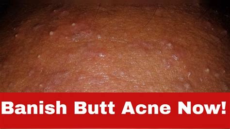 how to get rid of butt acne simple tips that actually work youtube
