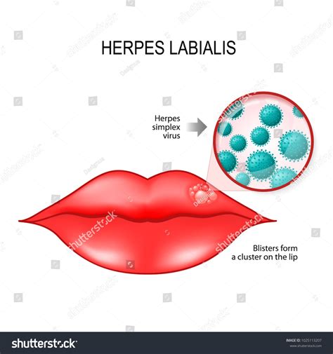 Herpes Labialis Blisters On Lip Cause Stock Illustration 1025113207