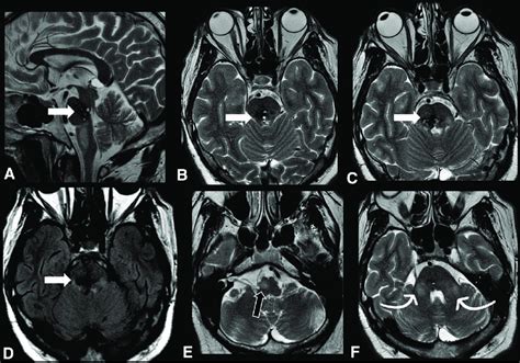 Axd Of The Pontocerebellar Tract A Sagittal And B C Axial T Wis And