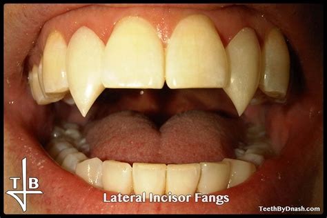 Lateral Incisor Teeth By Dnash
