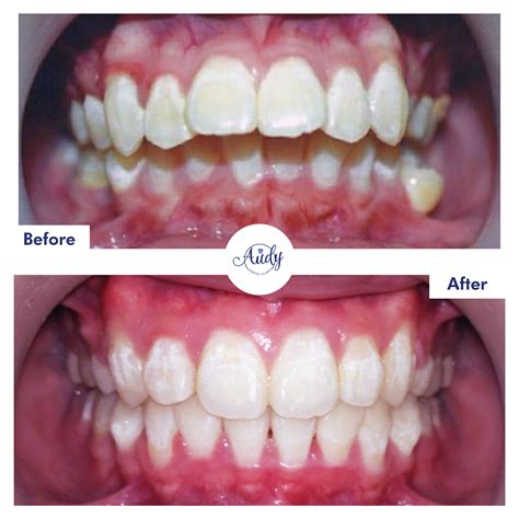 Behel Gigi | Audy Dental