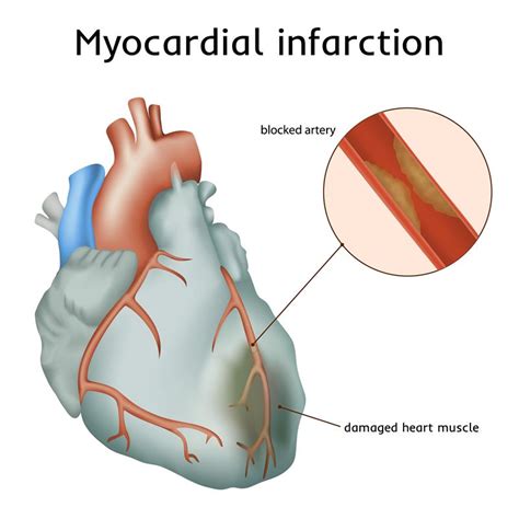 Atherosclerosis is by far the most common cause of myocardial infarction. Primary care management following an acute myocardial ...