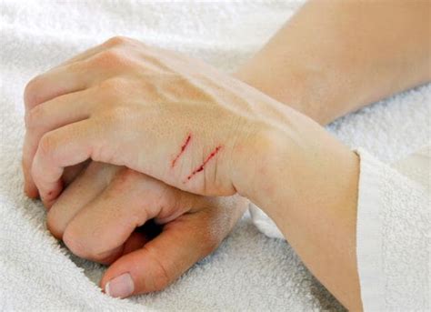 How To Treat Cat Scratches At Home Petmd