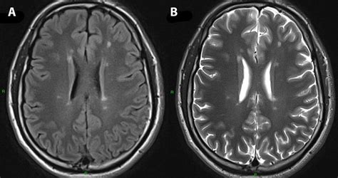 Axial FLAIR Left And T Right Brain MRI Show Multiple Lesions Download Scientific Diagram