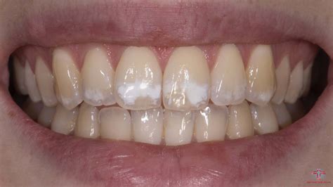 White Spots On Your Teeth