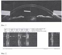 Диета при экссудативной эритеме Способ прогнозирования риска повышения внутриглазного давления Способ прогнозирования риска повышения внутриглазного давления Диета при экссудативной эритеме