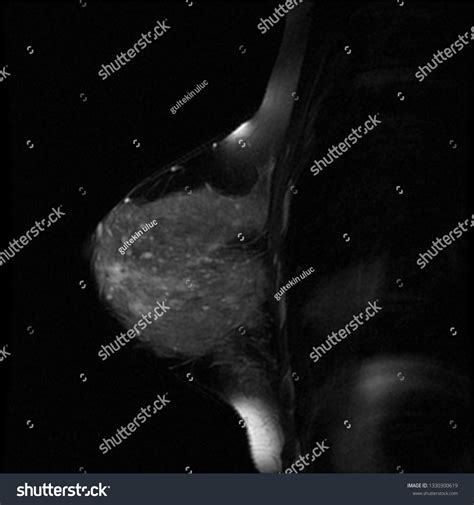 Breast Magnetic Resonance Image Breast Cysts Stock Photo 1330300619