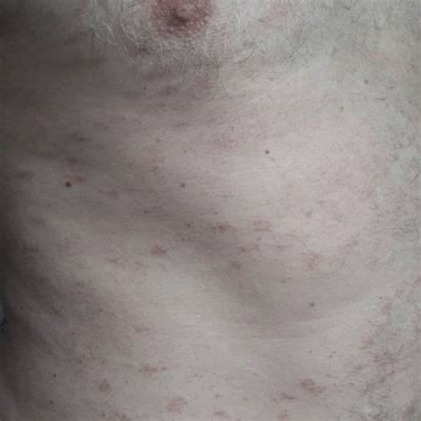 Small Plaque Parapsoriasis Digitate Dermatosis Variant