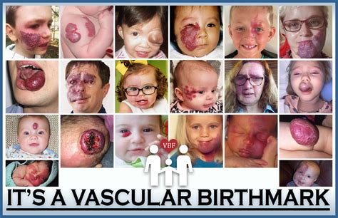 Maybe you would like to learn more about one of these? It's a Vascular Birthmark! - Birthmark Russia