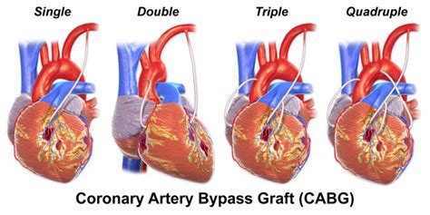 Illustration Depicting Single Double Triple And Quadruple Bypass