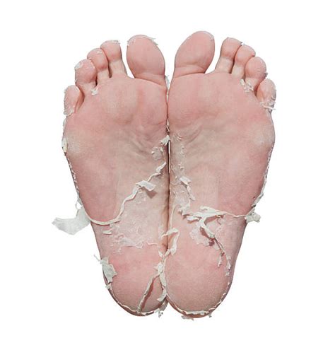 What Causes Peeling Feet Why Is The Skin Peeling On My Feet Buoy Vlr
