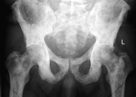Lower abdominal or pelvic pain is common, and changes to bowel or urinary habits are other signs. Sclerotic bone metastases from prostate cancer | Radiology ...