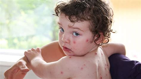 الطفح الجلدي عند الأطفال بالصور دليلك الطبي