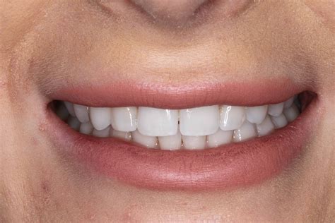 Smile Makeover Before And After Cosmetic Dentistry Portfolio