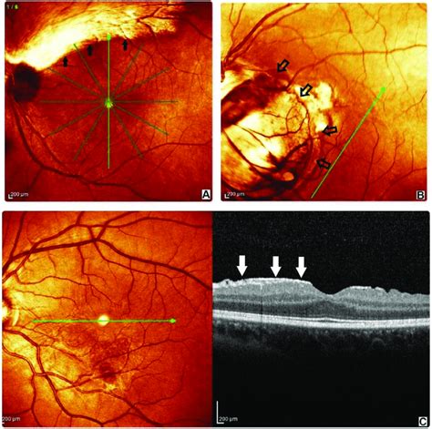 Spectral Domain Optical Coherence Tomography Sd Oct Findings In