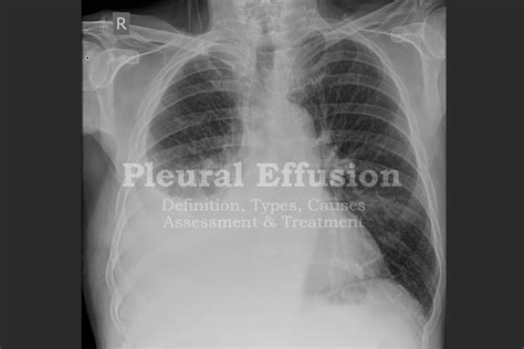 What Is Pleural Effusion How Is It Treated