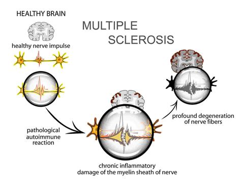 The Neuropsychiatry Of Multiple Sclerosis A Primer For Psychiatrists
