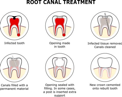 Root Canal Treatment Pure Dental Practice