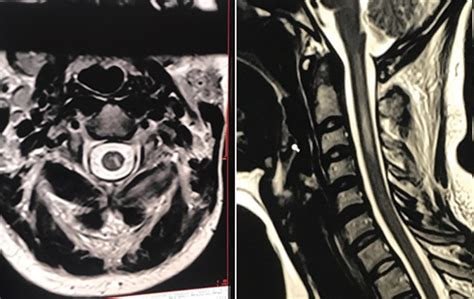 Complications Of Occipital Nerve Block And Radiofrequency Lesioning