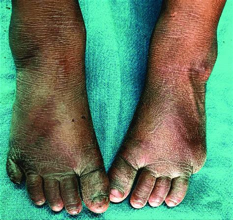 Ichthyosis And Lichenification Of The Skin Of Lower Limbs Note The