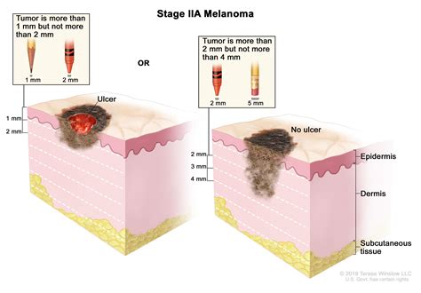 Melanoma Skin Cancer Treatment