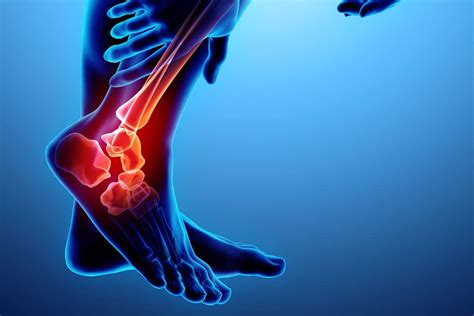 Understanding The Risks Of Ankle Sprains
