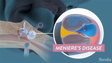 What Is Menieres Disease Entjc