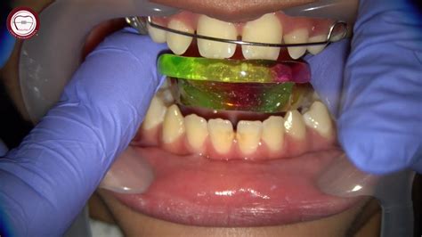 Step By Step Growth Modification By Activator In Orthodontics By Dr