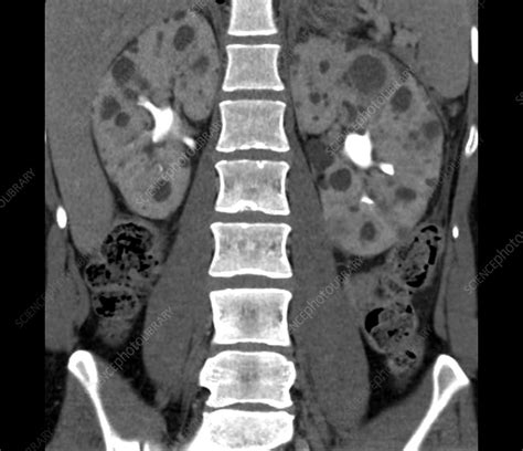 Polycystic Kidneys Ct Scan Stock Image C0525650 Science Photo