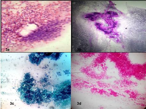 Fnac Of Salivary Gland Showing Acute Sialadenitis 3a Leishman Stain