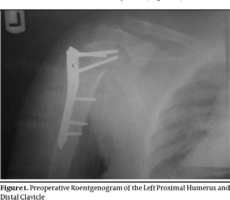 Figure 1 From Ipsilateral Traumatic Fractures Of The Proximal And