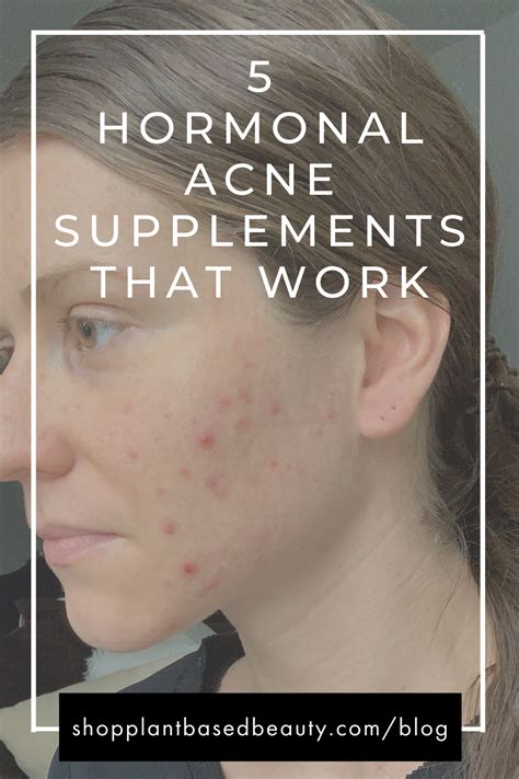 5 Hormonal Acne Supplements That Actually Work In 2021 Hormonal Acne
