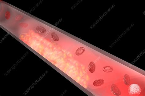 Clogged Blood Vessel Stock Image C0175084 Science Photo Library