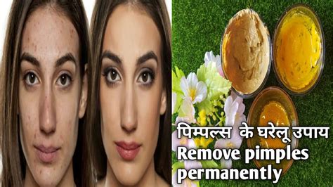 How To Remove Pimple Marks And Acne Scars Naturally At Home पिंपल्स