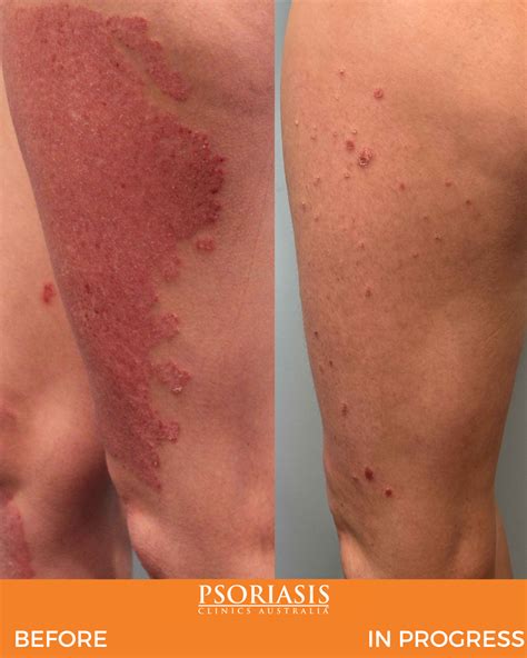 Psoriasis Before And After Treatment Psoriasis Clinics Australia