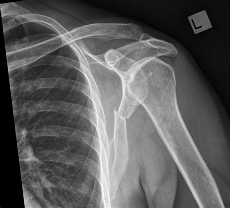 Oblique Shoulder For Scapular Fractures WikiRadiography