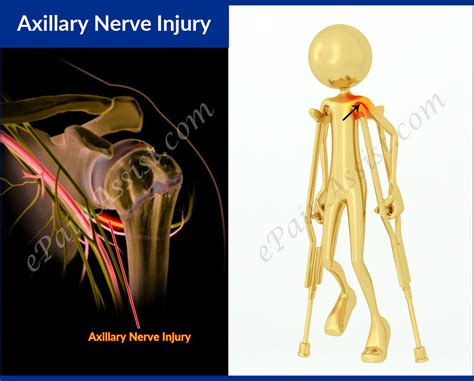 Axillary Nerve Injury Or Axillary Neuropathysymptomscausestreatment Emg