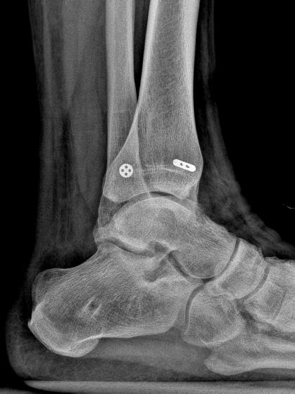 Management Of A Dislocated Talar Dome Fracture With Ankle