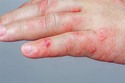 The Real Suffering Of Shingles Blue Heron Natural Health News