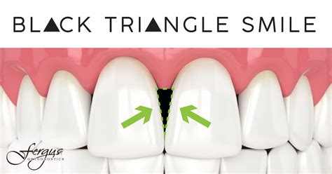Why Do I Have Black Triangles In My Teeth Jonesboro Ar